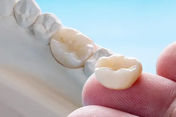 Dental Crowns