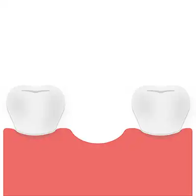 Missing Tooth Implants Bundaberg QLD