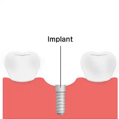 Dental Implant Placement Bundaberg QLD