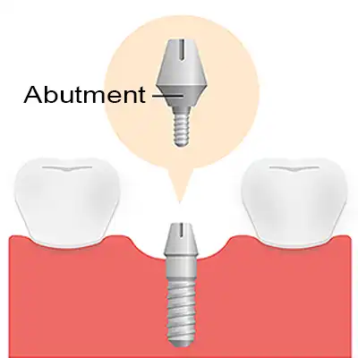 Dental Abutment Placement Bundaberg QLD