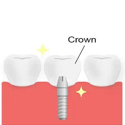 Crown Placement Bundaberg QLD