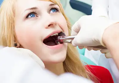 Wisdom Teeth Removal Bundaberg QLD