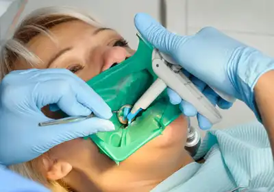 Root Canal Treatment Bundaberg QLD