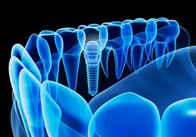 Dental Implants Bundaberg QLD