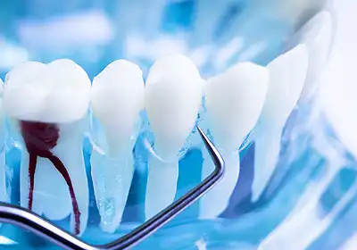 Root Canal Treatment Bundaberg QLD